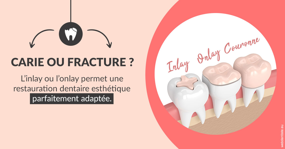 https://www.drbenoitphilippe.fr/T2 2023 - Carie ou fracture 2