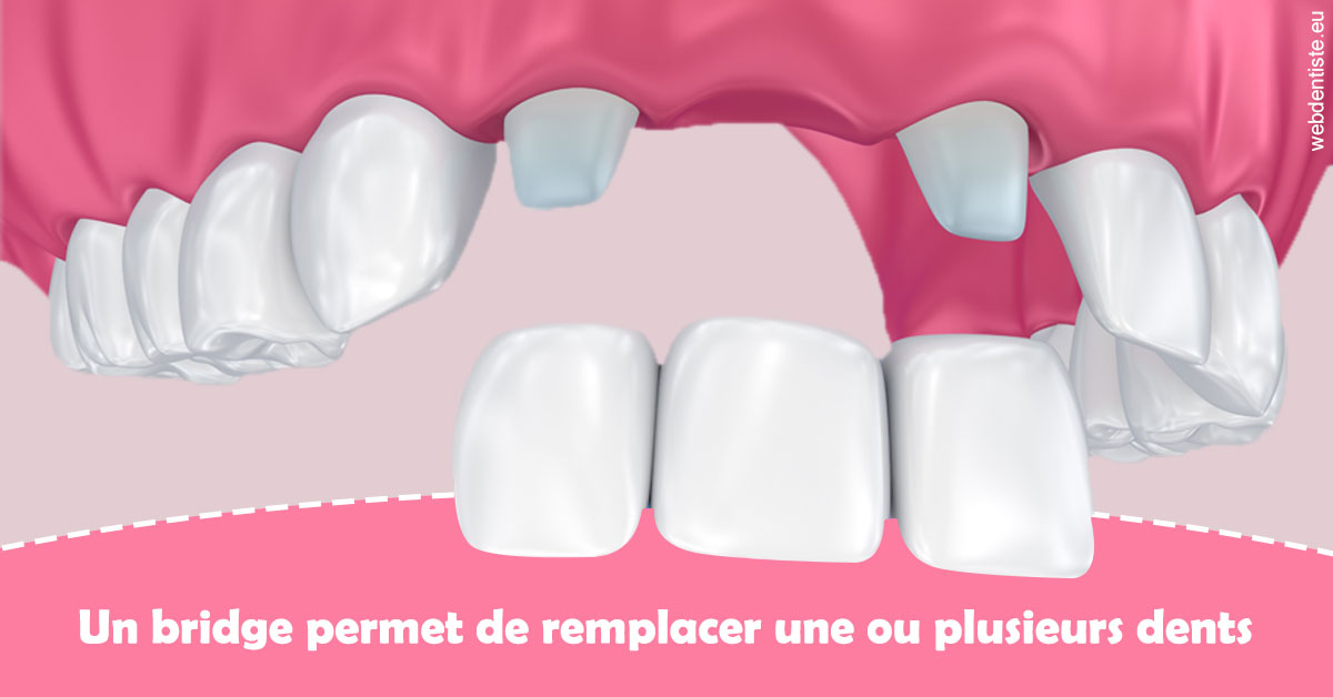 https://www.drbenoitphilippe.fr/Bridge remplacer dents 2