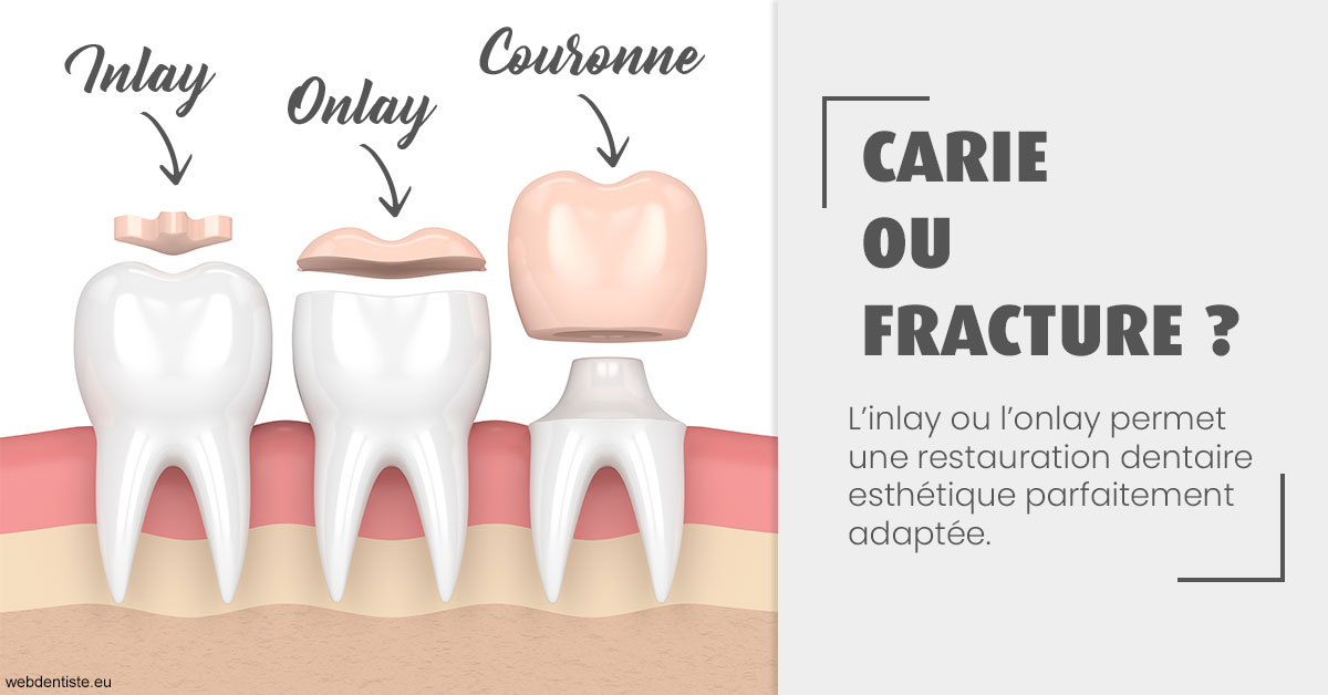 https://www.drbenoitphilippe.fr/T2 2023 - Carie ou fracture 1