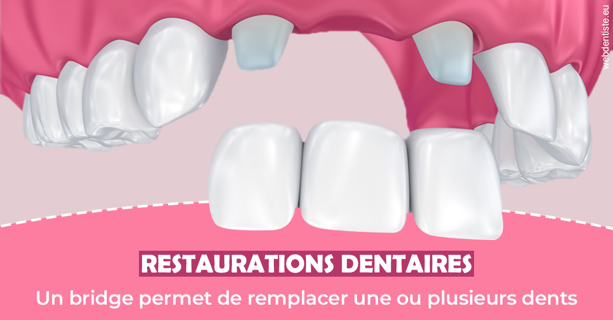 https://www.drbenoitphilippe.fr/Bridge remplacer dents 2