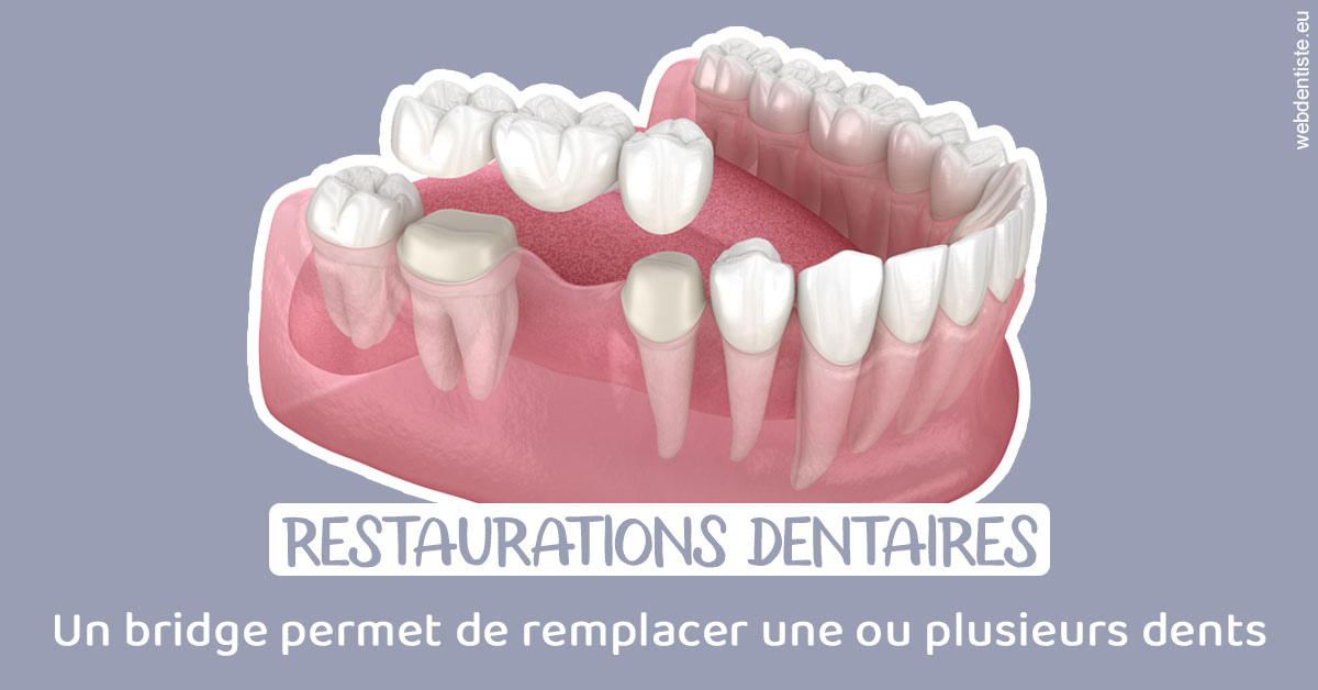 https://www.drbenoitphilippe.fr/Bridge remplacer dents 1