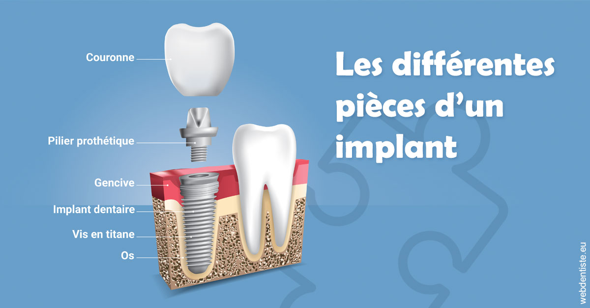 https://www.drbenoitphilippe.fr/Les différentes pièces d’un implant 1